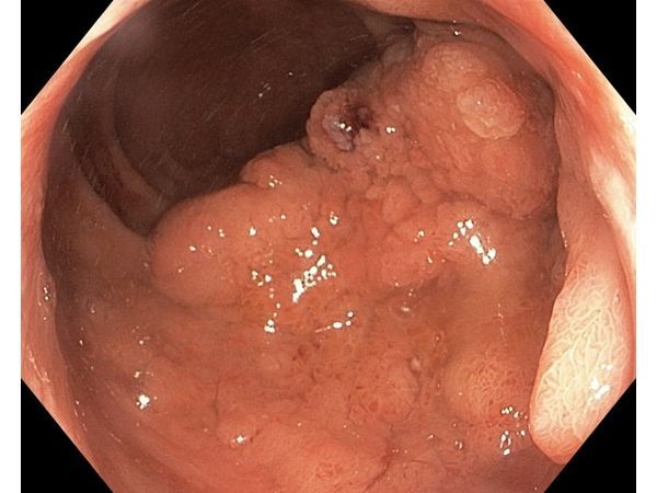 Новообразование прямой кишки Новообразование прямой кишки