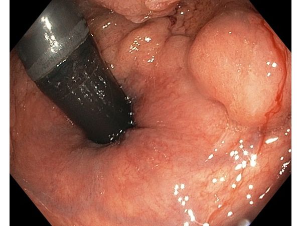 Новообразование прямой кишки (вид в реверсе) Новообразование прямой кишки (вид в реверсе)