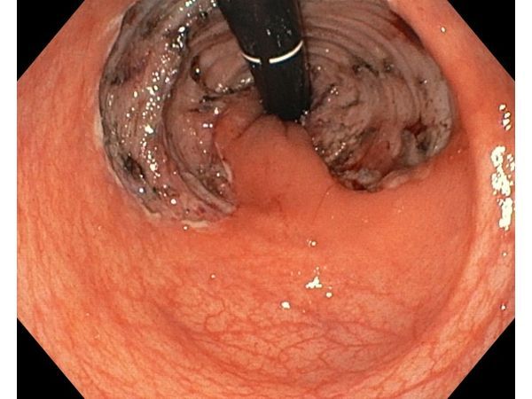 Рана сразу после удаления новообразования Рана сразу после удаления новообразования