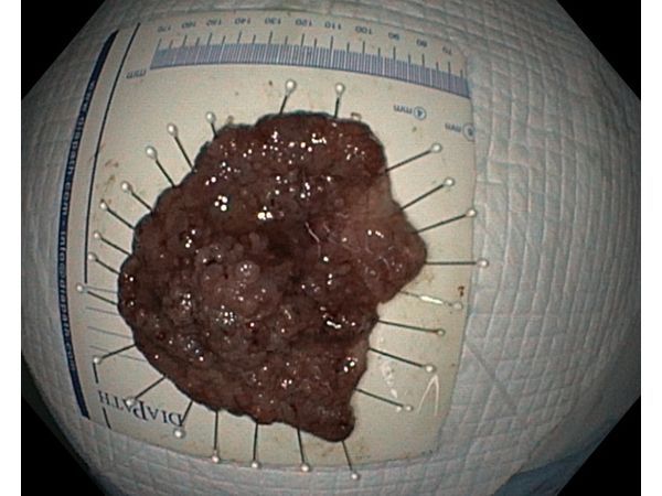 Удалённое новообразование Удалённое новообразование