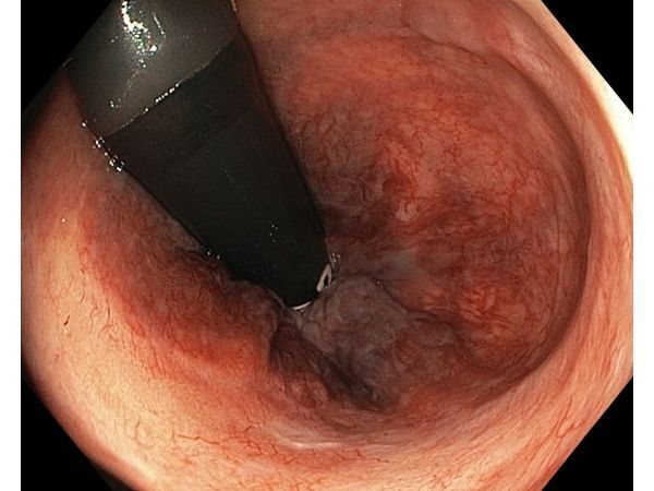 Зажившая рана (белый рубец) спустя год после операции (вид в реверсе) Зажившая рана (белый рубец) спустя год после операции (вид в реверсе)