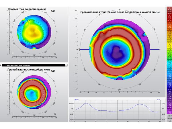 Правильное воздействие ночной линзы на роговицу