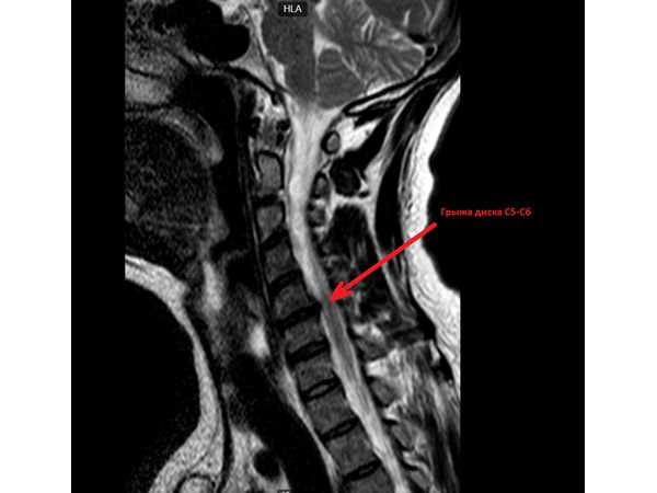 Вертеброгенная цервикалгия мкб