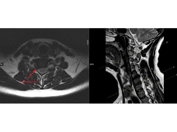 Грыжа диска С6-С7