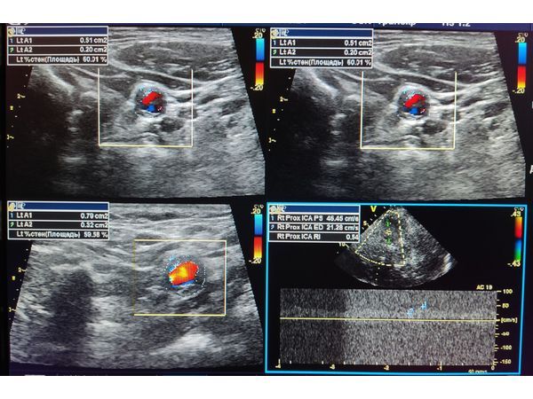 УЗДГ брахиоцефальных сосудов