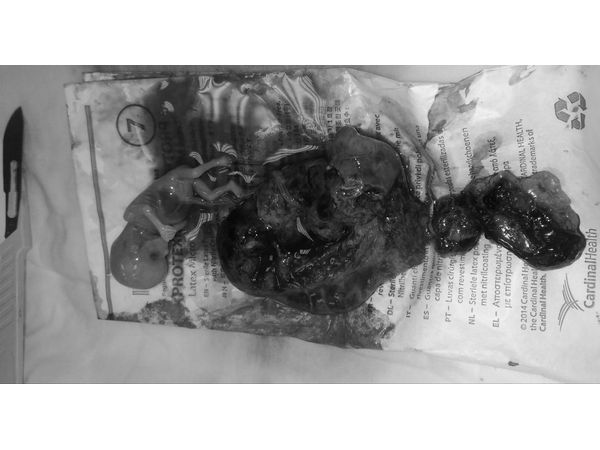 Удалённый плод и плацентарная площадка Удалённый плод и плацентарная площадка