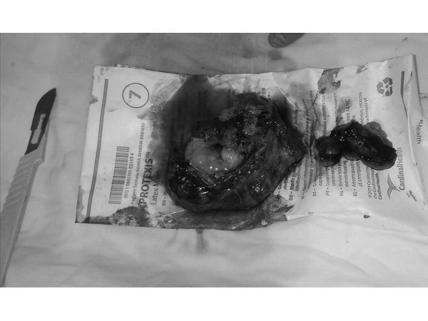 Удалённый плод и плацентарная площадка Удалённый плод и плацентарная площадка