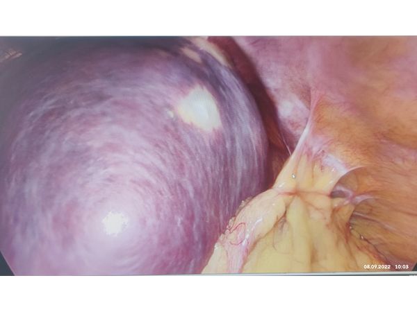 Лапароскопия: киста селезёнки Лапароскопия: киста селезёнки