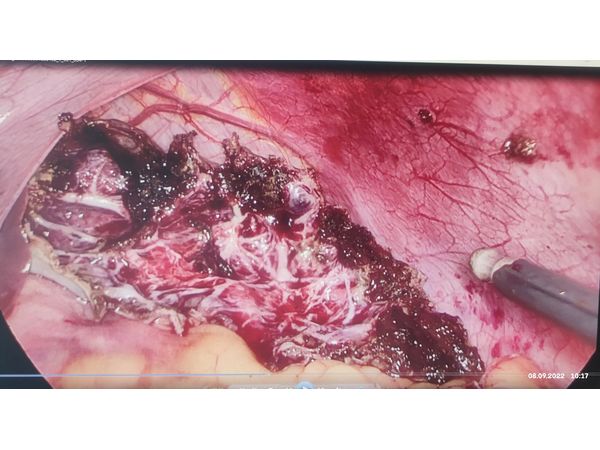 Лапароскопия: вид после иссечения кисты Лапароскопия: вид после иссечения кисты