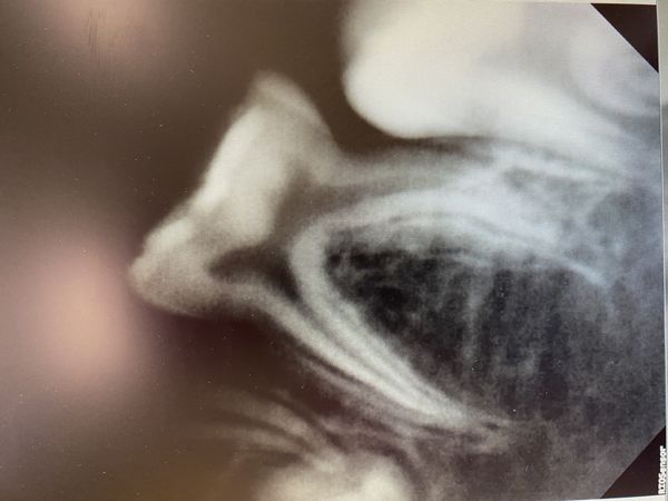 Зуб 7.5 без зачатка постоянного зуба Зуб 7.5 без зачатка постоянного зуба