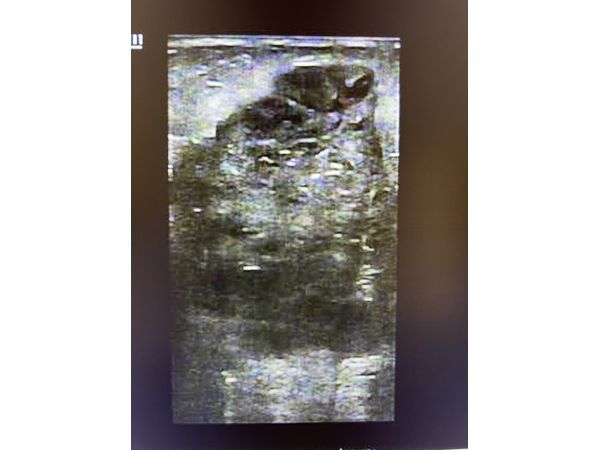 Подтверждённый рак правой молочной железы Подтверждённый рак правой молочной железы