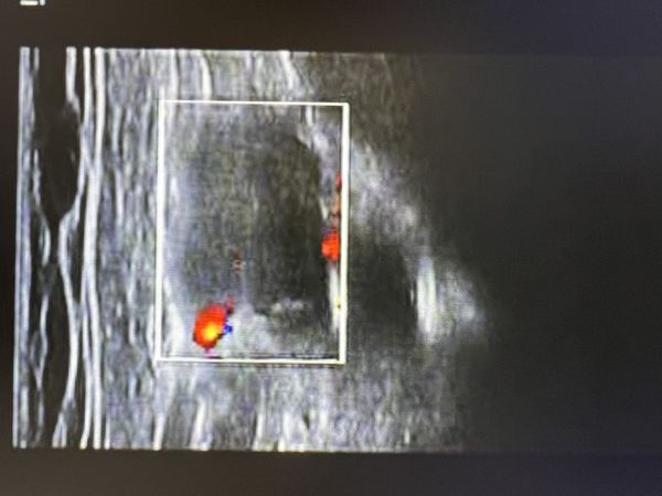 Метастатическое поражение подключичного лимфоузла справа Метастатическое поражение подключичного лимфоузла справа