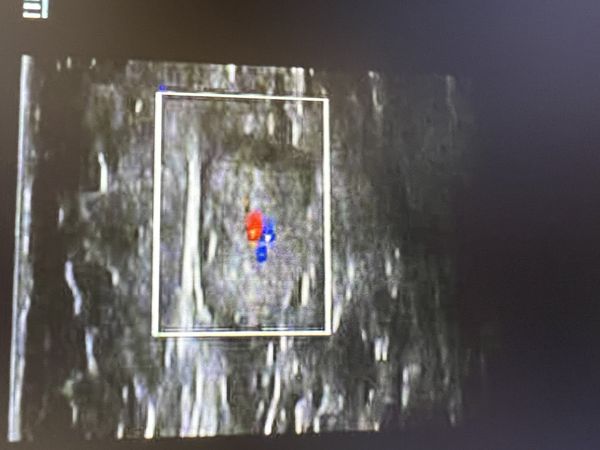 Изменённый подмышечный лимфоузел справа Изменённый подмышечный лимфоузел справа