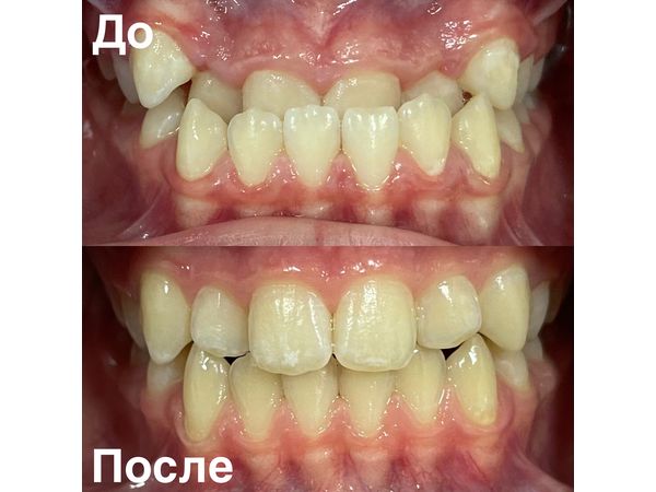 До и после лечения