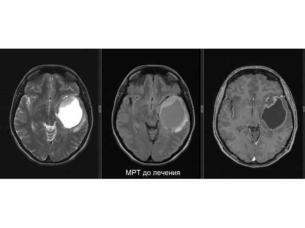 МРТ до лечения (февраль 2019 года)