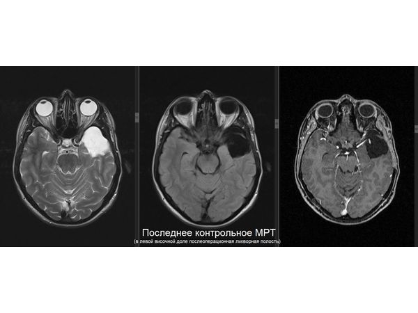 Контрольное МРТ в январе 2023 года