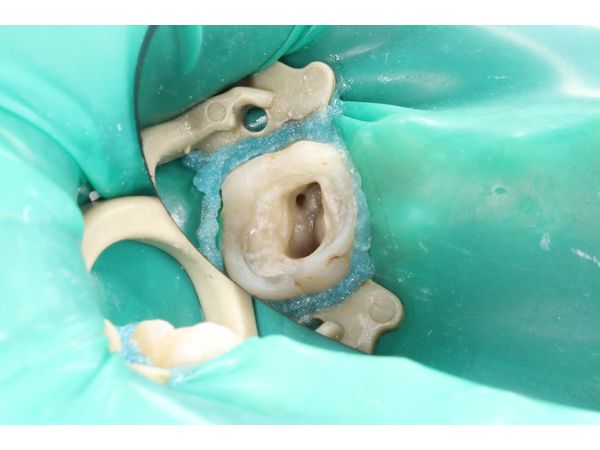 Обработанные корневые каналы