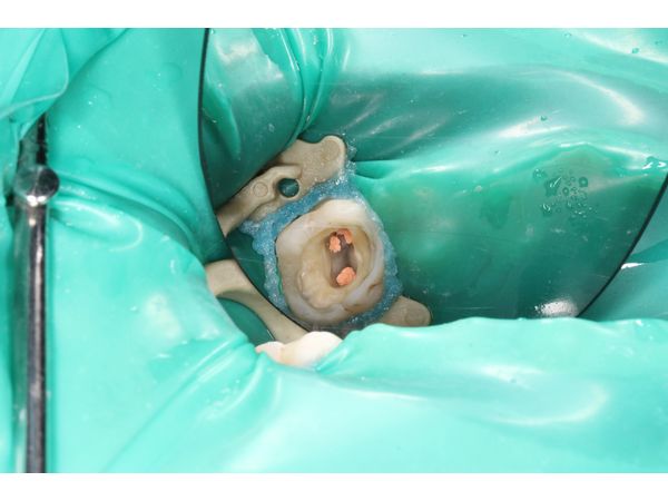 Запломбированные корневые каналы