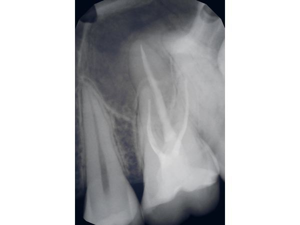 Рентген-контроль запломбированных корневых каналов и коронковой части