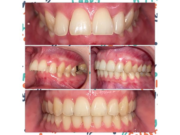 До и после лечения: картина справа и анфас