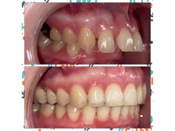 До и после лечения: картина слева