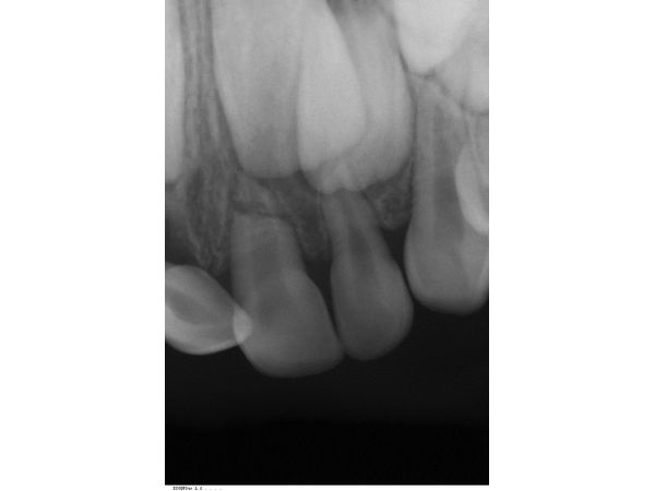 Первый исходный прицельный рентгенологический снимок Первый исходный прицельный рентгенологический снимок
