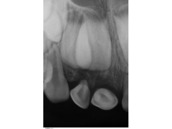 Второй исходный прицельный рентгенологический снимок Второй исходный прицельный рентгенологический снимок