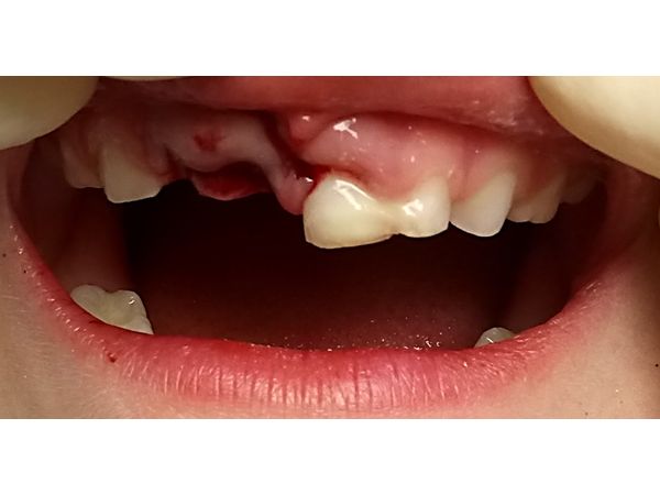 После шинирования и удаления зубов После шинирования и удаления зубов