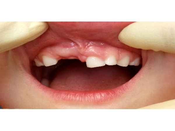 Состояние полости рта через год Состояние полости рта через год