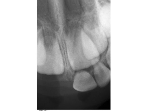 Прицельный рентгенологический снимок через 2 года после травмы Прицельный рентгенологический снимок через 2 года после травмы