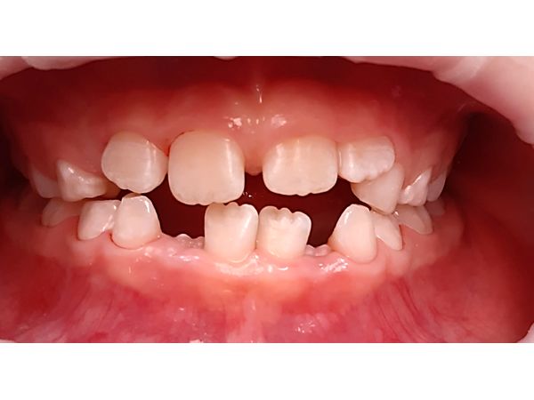 Через три года после травмы Через три года после травмы