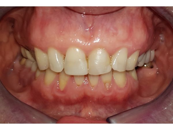 До лечения: вид спереди