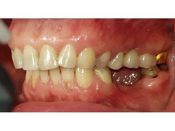 До лечения: вид слева