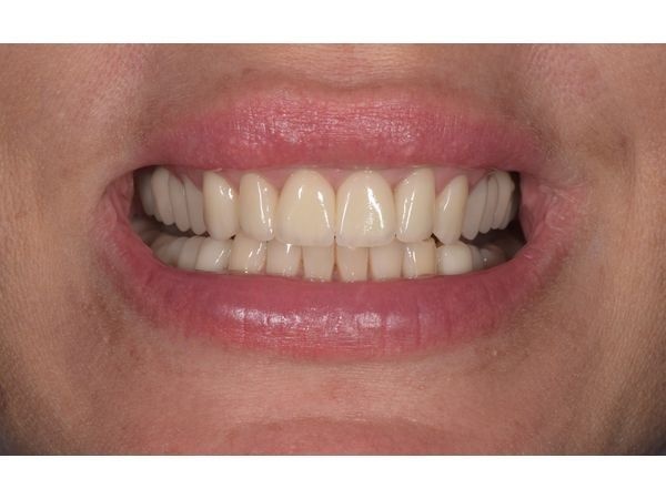 Новые керамические зубы в улыбке