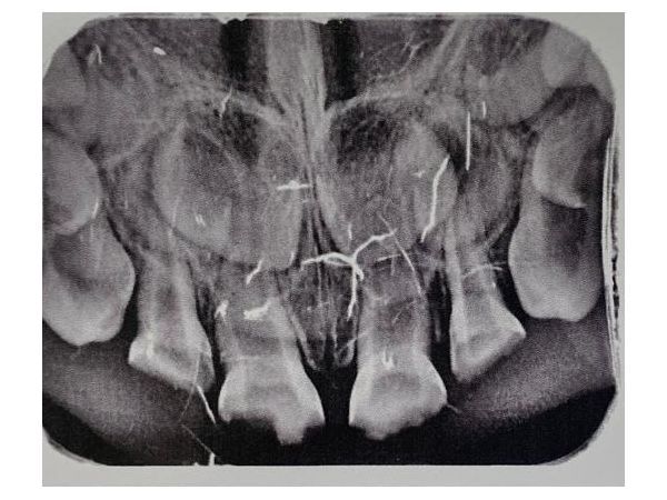 Прицельная рентгенограмма до лечения Прицельная рентгенограмма до лечения