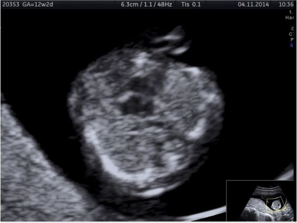 Левые отделы сердца меньше правых