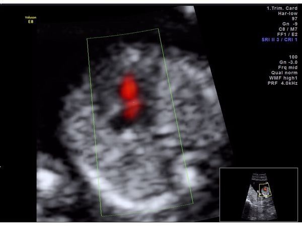 Ток крови через трикуспидальный клапан в правых отделах сердца