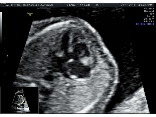 Дефект межпредсердной перегородки с расщеплением створок атриовентрикулярных клапанов