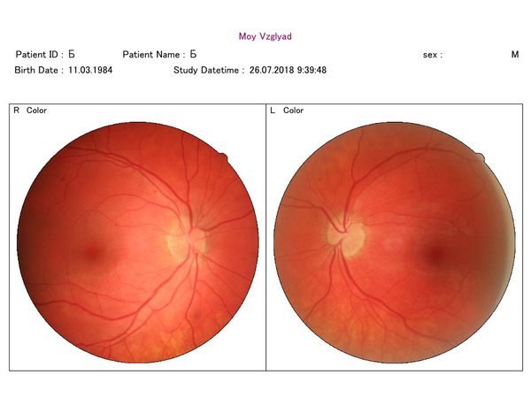 Фото глазного дна через 3 месяца