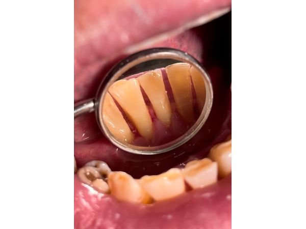 Чистые зубы после лечения