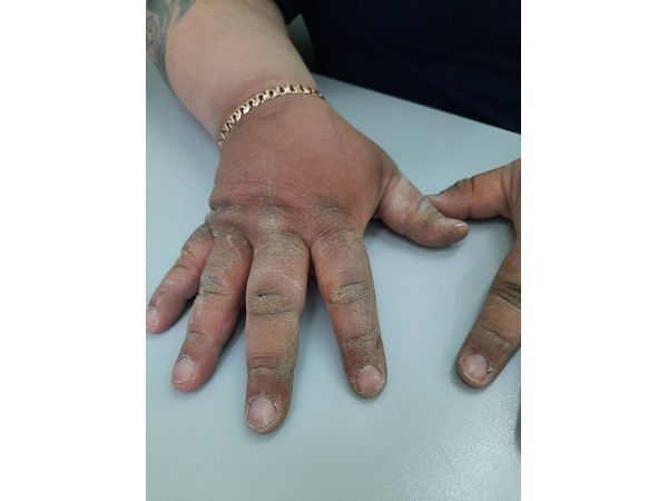 Выраженная сухость рук