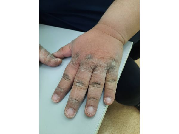 Гиперкератоз