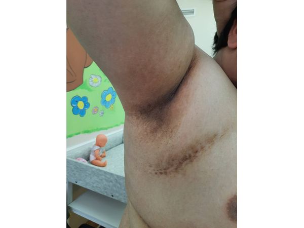 Гиперпигментация