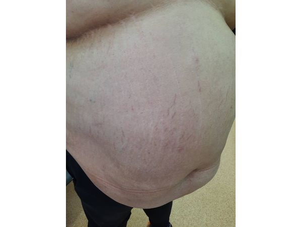 Полосы на животе