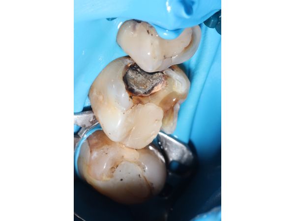 Кариес под пломбой