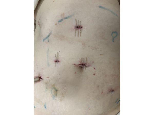 Наложенные швы на проколы сразу после операции Наложенные швы на проколы сразу после операции