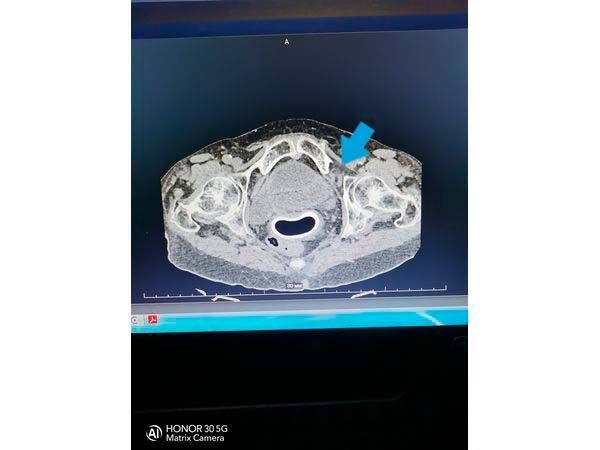 Выход грыжи в запирательное отверстие слева Выход грыжи в запирательное отверстие слева