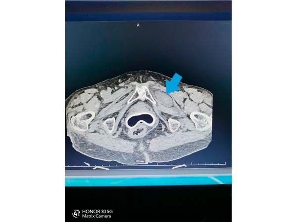 Грыжа запирательного отверстия слева Грыжа запирательного отверстия слева