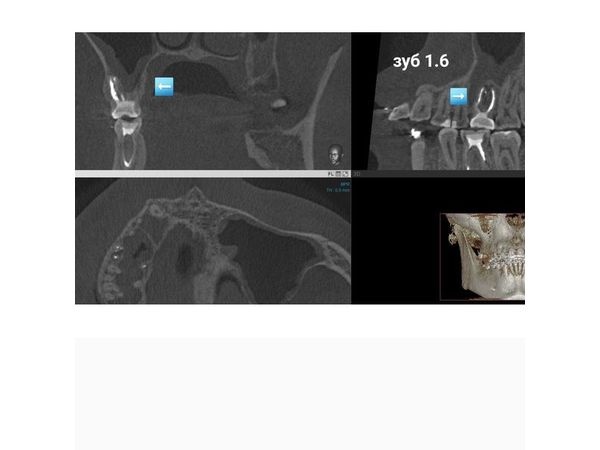 Зуб 1.6 на снимке КТ после лечения Зуб 1.6 на снимке КТ после лечения