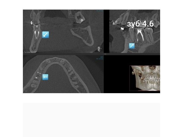 Зуб 4.6 на снимке КТ после лечения Зуб 4.6 на снимке КТ после лечения